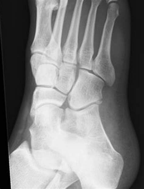 Cuboid Fracture Healing