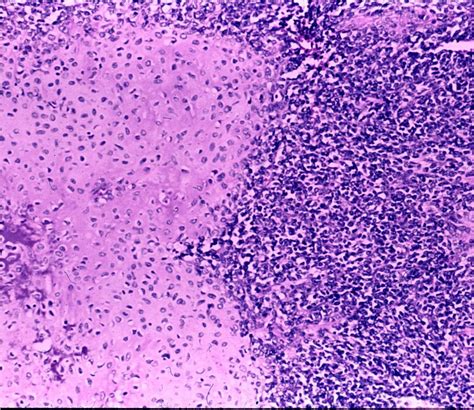 Mesenchymal Chondrosarcoma