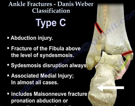 Weber Classification Ankle