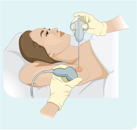 Lymph node biopsy - Lymphoma Australia