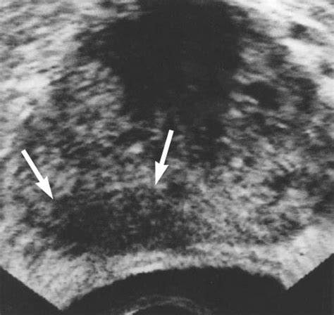 Prostate Imaging