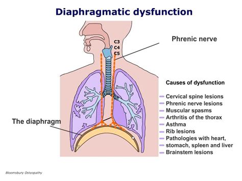 Diaphragmatic dysfunction TSPP01 - Bloomsbury Health Centre