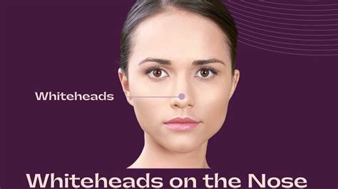 Whiteheads on the Nose: Causes, Treatments, Prevention