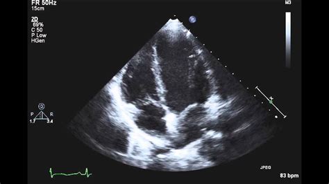 TTE Normal Apical 4 chamber Example 1 - YouTube