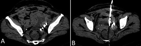 Computed tomography-guided percutaneous drainage of a pelvic abscess