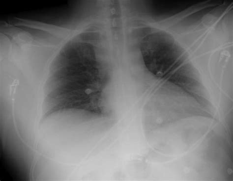 Chest X-ray at admission. Anteroposterior supine chest X-ray performed ...