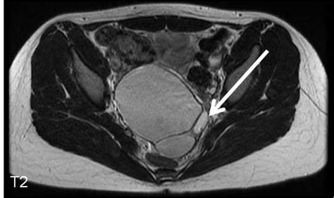 Ovarian Dermoid Cyst MRI | RADIOLOGYPICS.COM