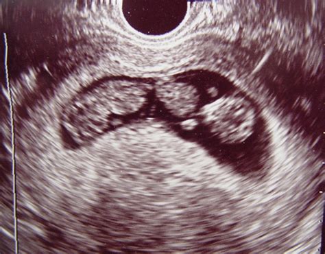 Gender Ultrasound: First Trimester Gender Ultrasound