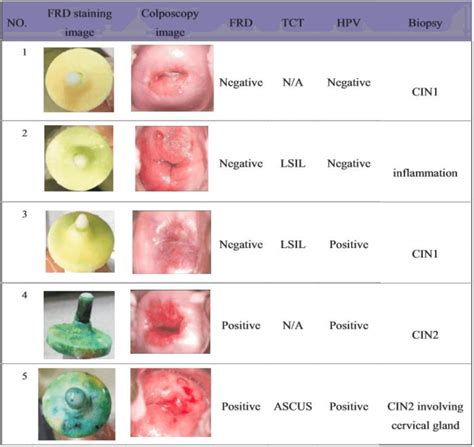 Cervical Cancer In Malaysia / Vinegar test helpful vs cervical cancer | Inquirer Lifestyle ...