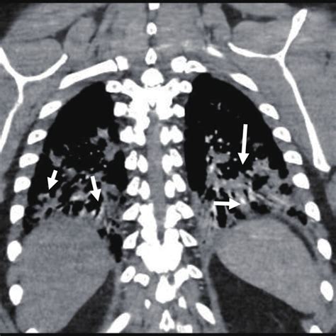 Diffuse patchy lung infiltrates, predominantly in both lung bases, with... | Download Scientific ...