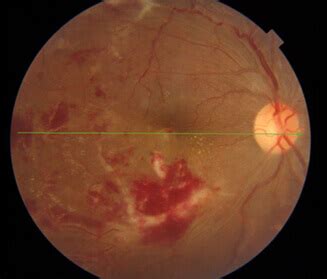 Cystoid Macular Oedema: Causes, Symptoms and Treatment | Neoretina