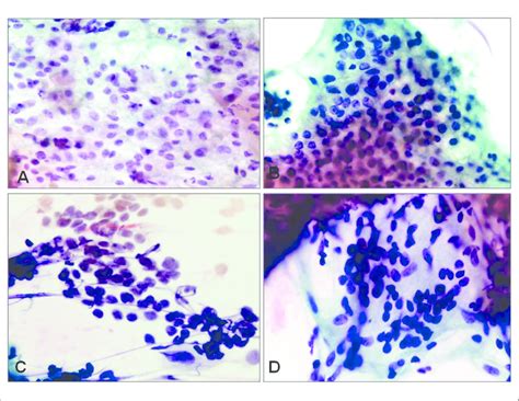 (A and B) This thyroid fine-needle aspiration (FNA) was interpreted as... | Download Scientific ...