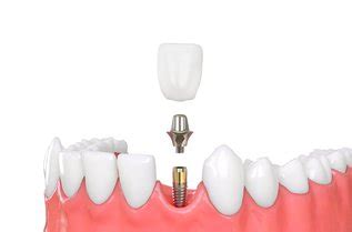 Dental Crown vs Filling: What to Consider When Choosing | Skymark Smile ...