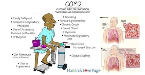 Tripod Position Copd