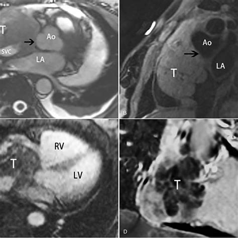 CT features of a malignant peripheral nerve sheath tumor in right... | Download Scientific Diagram