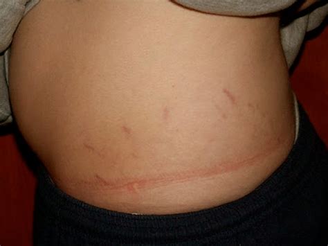 👉 Bartonella - Symptoms, Treatment, Pictures, Causes (February 2022)