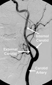 Carotid Angiography and Stenting - Riverside, CA