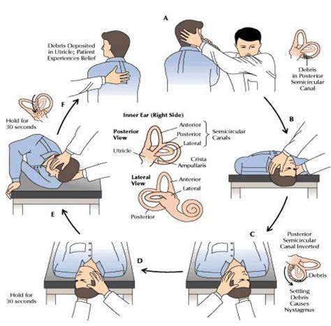 BPPV (Benign Paroxysmal Positional Vertigo) | Prometpt