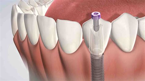 What to expect after dental implant surgery - Dental News Network