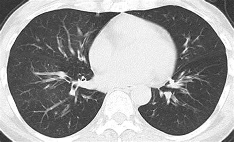 Bronchiolitis obliterans in a 54-year-old woman. Transverse... | Download Scientific Diagram