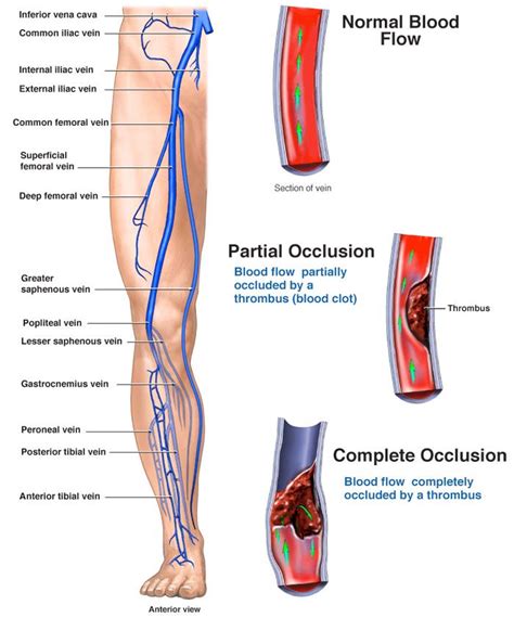 Deep vein thrombosis symptoms and treatment