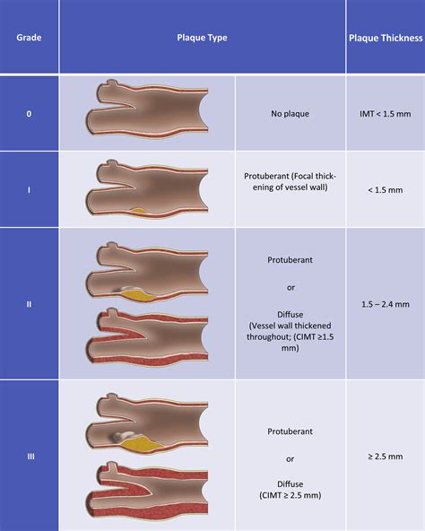 Carotid Artery Plaque Ultrasound