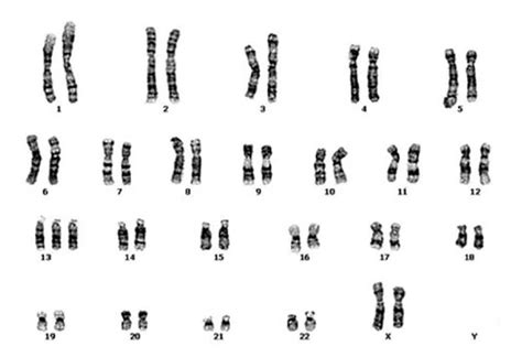 A karyotype of Patau syndrome- Explained. – KaryotypingHub