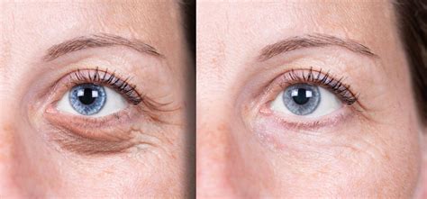 Laser Resurfacing Under the Eyes