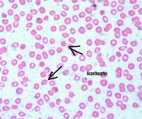 [Figure, Acanthocytes found in the peripheral...] - StatPearls - NCBI ...