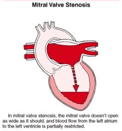 Mitral Valve Stenosis or Regurgitation