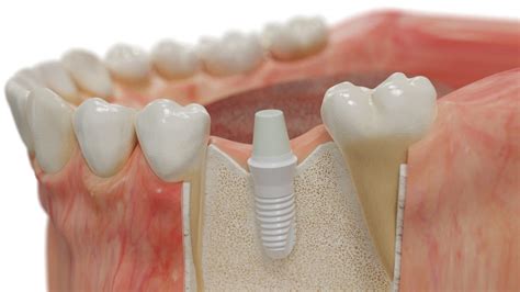 Zirconia Dental Implants Marietta | West Cobb Periodontics