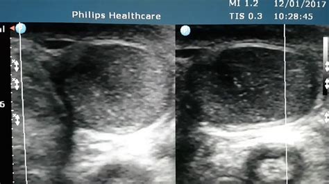 Testicular Microlithiasis Ultrasound - YouTube