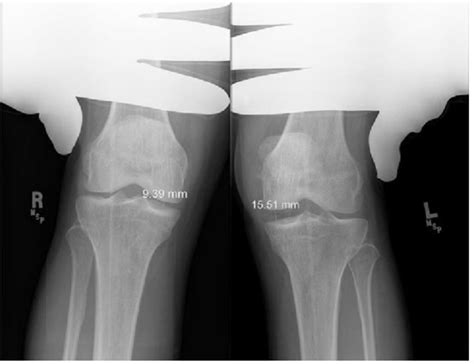 Stress Radiographs of the Knee - Sports Medicine Review