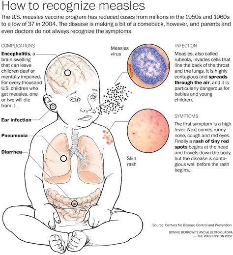 New data shows a deadly measles complication is more common than thought - The Washington Post