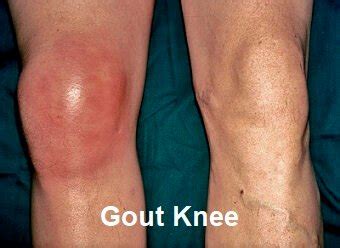 Gout Knee: Causes, Symptoms & Treatment - Knee Pain Explained