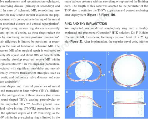 New annuloplasty ring. Transverse and coronal plane of the annuloplasty ...