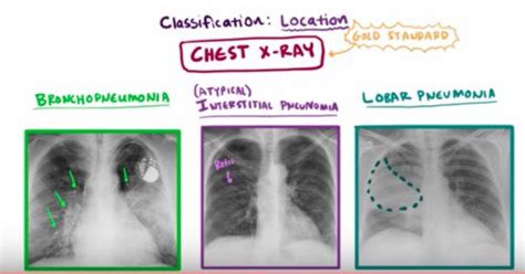 Interstitial Pneumonia X Ray