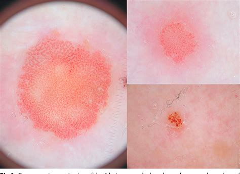 Figure 2 from Dermoscopy of clear cell acanthoma. | Semantic Scholar