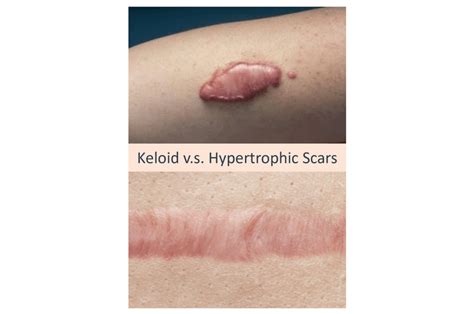 Keloid Acne Scars: What Are They And How To Get Rid of Them? – Dream Plastic Surgery