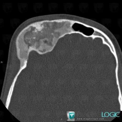 Radiology case : Fibrous dysplasia (CT) - Diagnologic