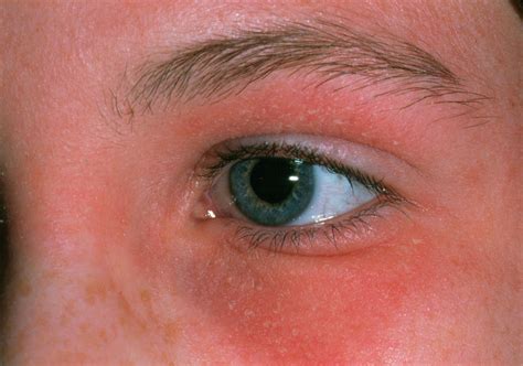 Eczema Around Eye Photograph by Dr P. Marazzi/science Photo Library