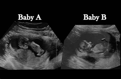 Identical Twins Ultrasound 12 Weeks