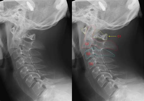 Cervical Fracture