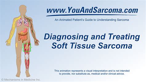 Diagnosing and Treating Soft Tissue Sarcoma