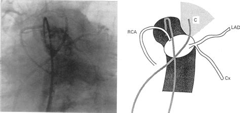 End-on aortogram with catheter (C) in main pulmonary artery. This... | Download Scientific Diagram