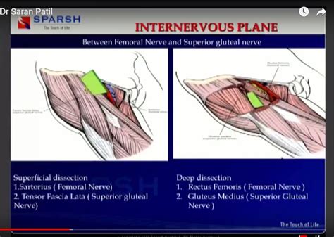 Direct Anterior Approach for Total Hip Replacement ...