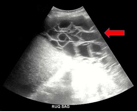 Sagittal view of the right upper quadrant abdominal ultrasound also... | Download Scientific Diagram