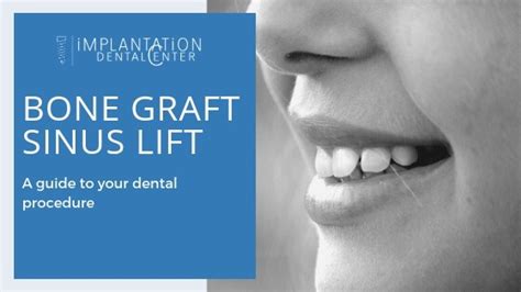 bone-graft-sinus-lift · Implantation Dental Center