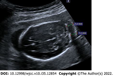 Thickened nuchal fold. 25-year-old, first pregnancy, 19 wk of... | Download Scientific Diagram