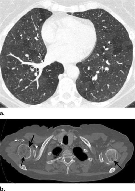 Mosaic attenuation in a 41-year-old woman with shortness of breath. (a)... | Download Scientific ...